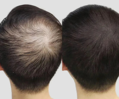 Lustrao Complete Regrowth System – (Shampoo, Conditioner, Öl, Scalp Massager & Derma Roller)