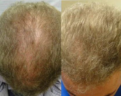 Lustrao Complete Regrowth System – (Shampoo, Conditioner, Öl, Scalp Massager & Derma Roller)